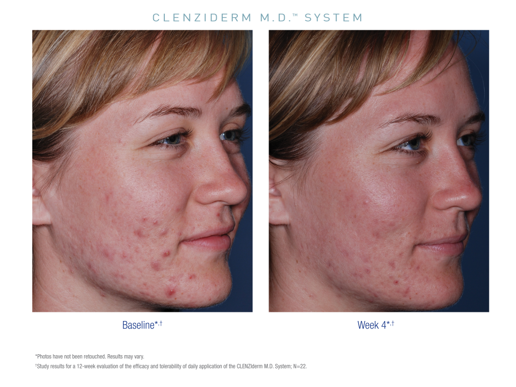 Obagi CLENZIderm Pore Therapy before and after