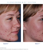 Obagi CLENZIderm Pore Therapy before and after