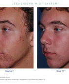 CLENZIderm  Before and after
