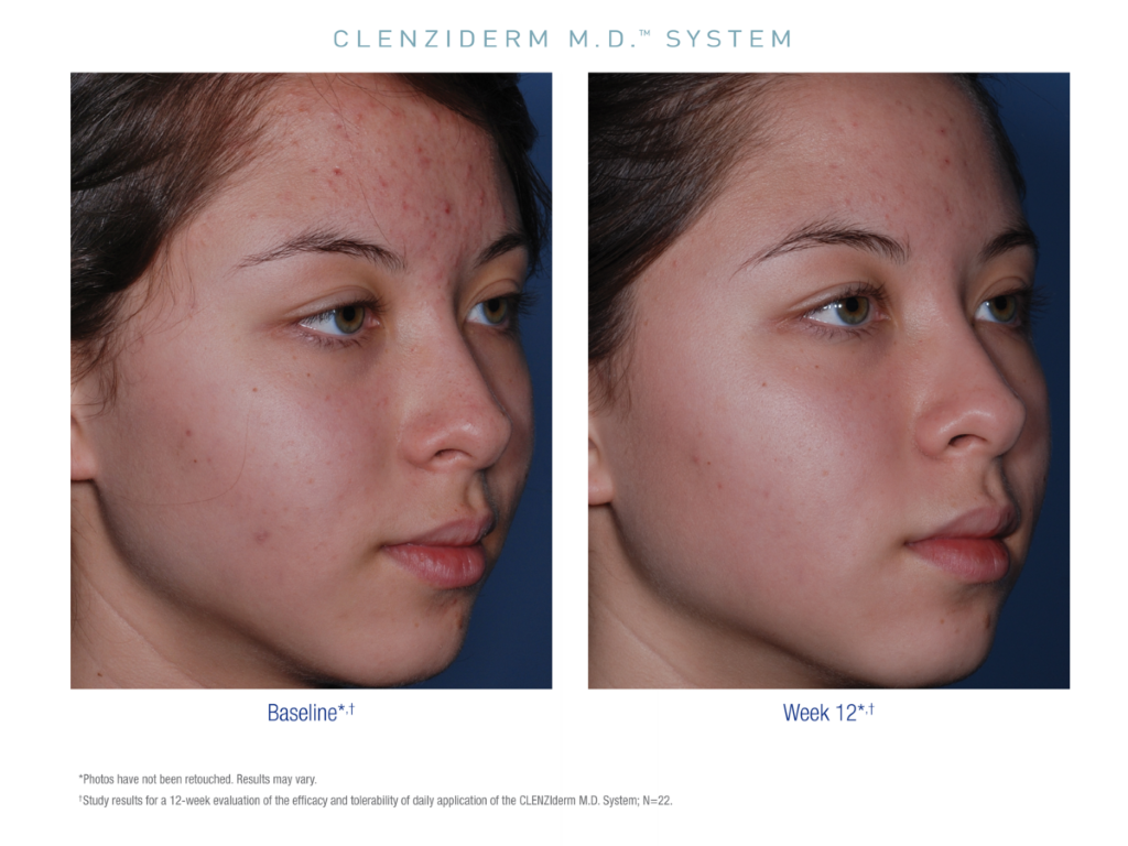 CLENZIderm Therapautic Lotion before and after