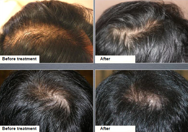 XCellarisPRO Hair Treatment before and after