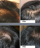 XCellarisPRO Hair Treatment before and after